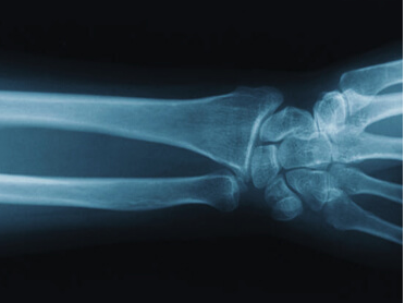 How to tell if you need an x-ray - Envision Radiology